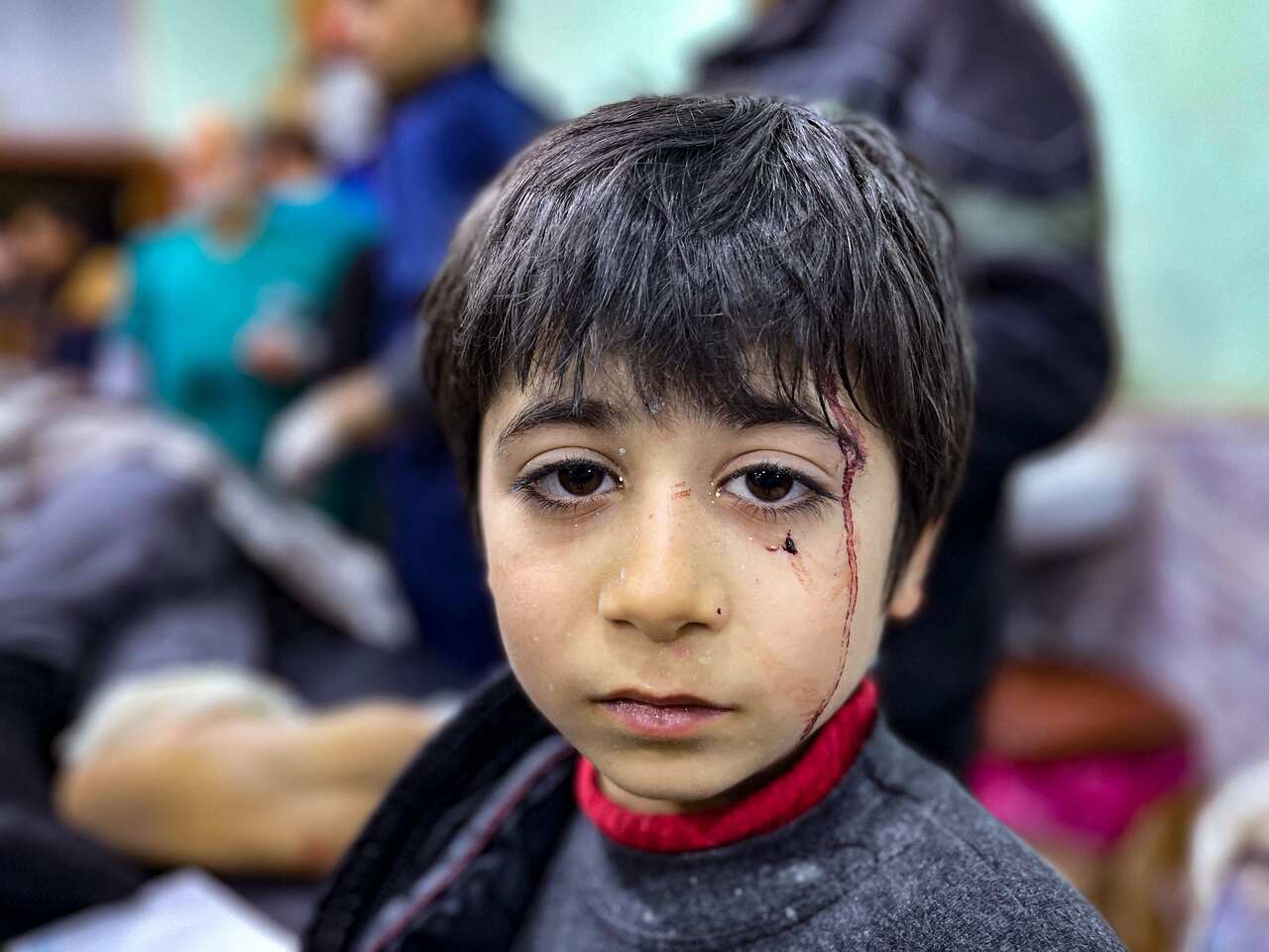 A young boy looks at the camera, injured. 