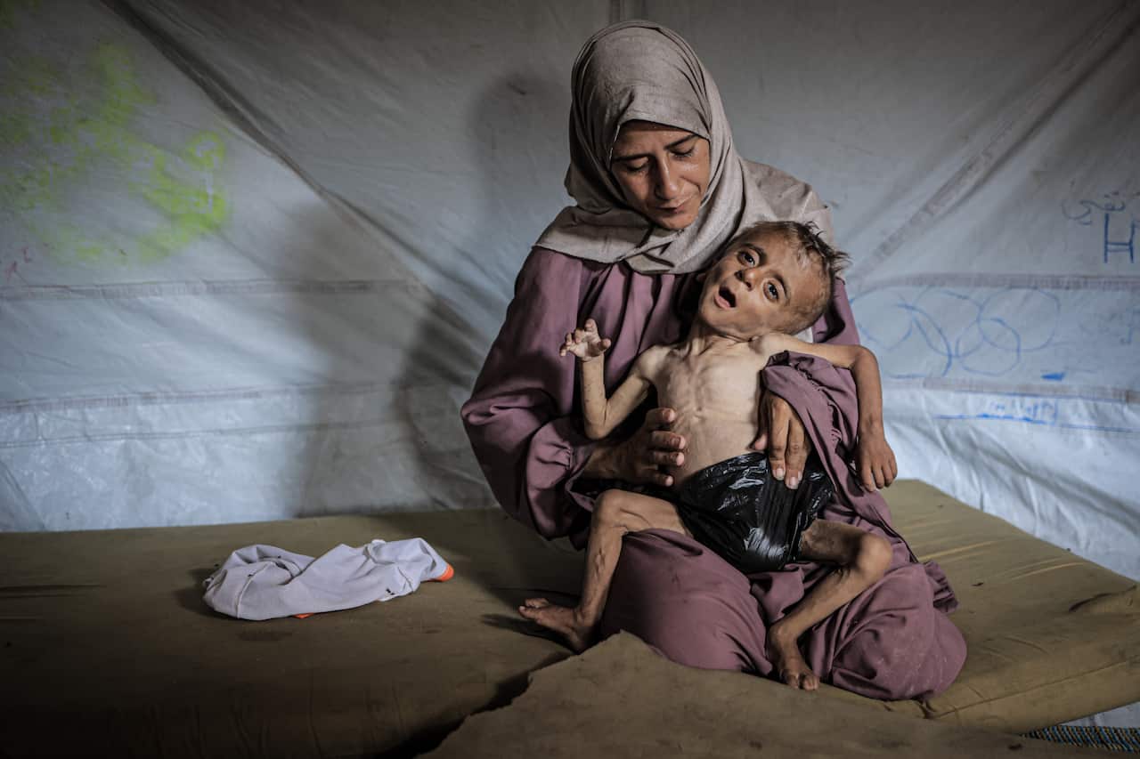Woman holds malnourished toddler in tent