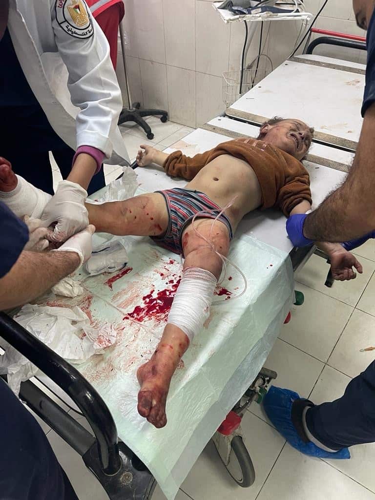 An injured child receives treatment in the hospital in Gaza. He has a leg wound that is bandaged.