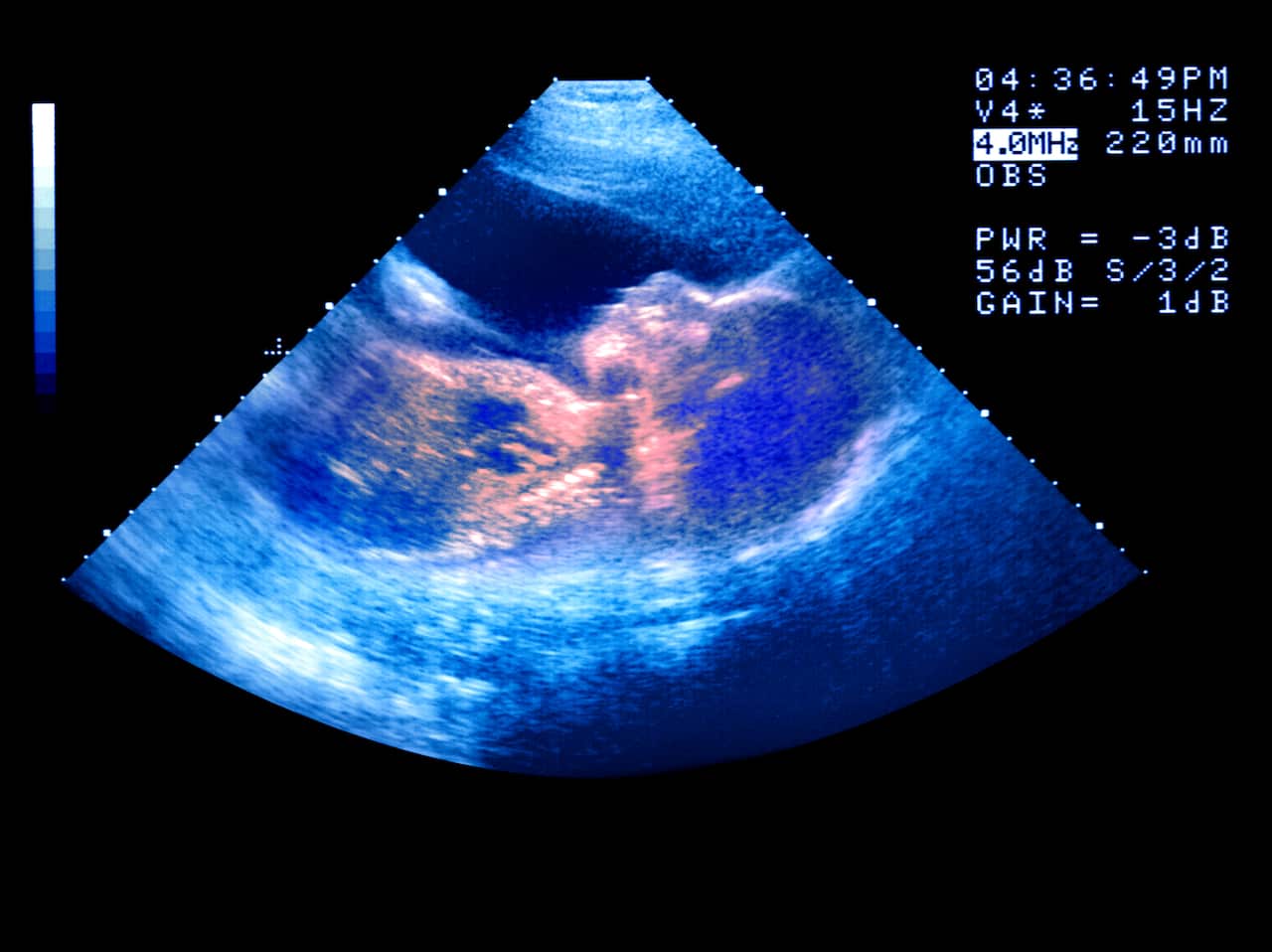 Multicoloured image of ultrasound showing the head and body of a fetus.