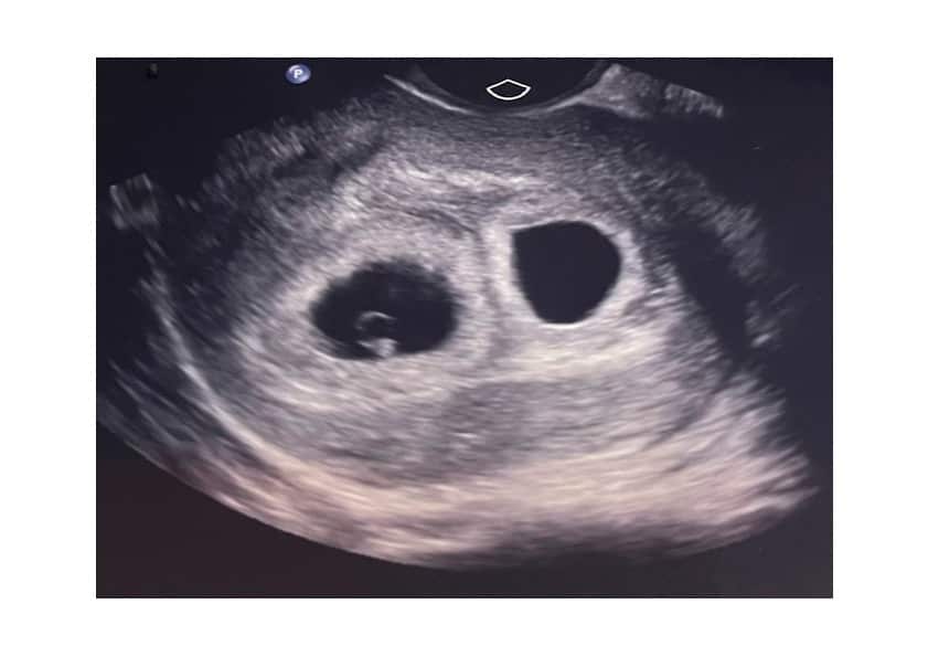 A six-week pregnancy ultrasound showing two developing embryos, which grew into twin girls.