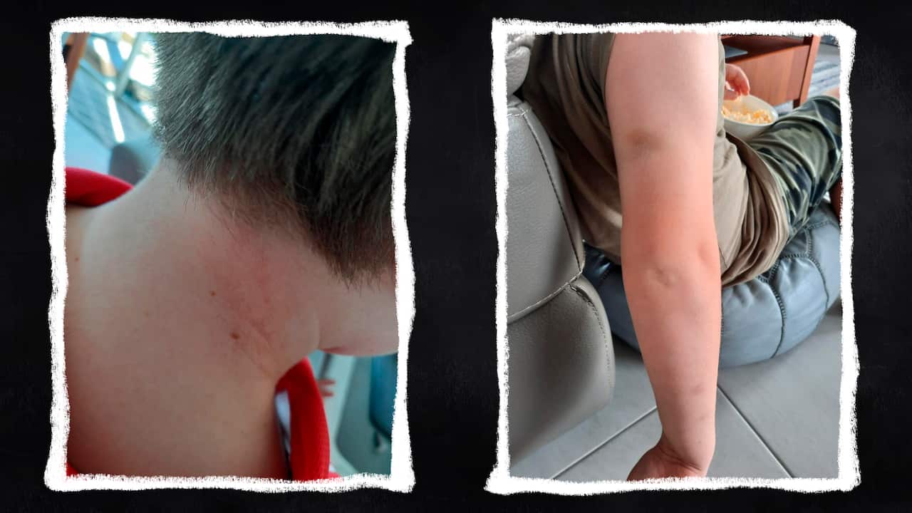 Two photos show bruises on a young child's neck and arm. 
