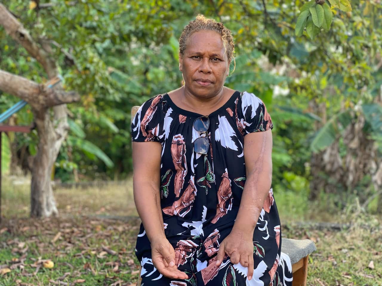 A woman with a scar on her arm and some fingers missing