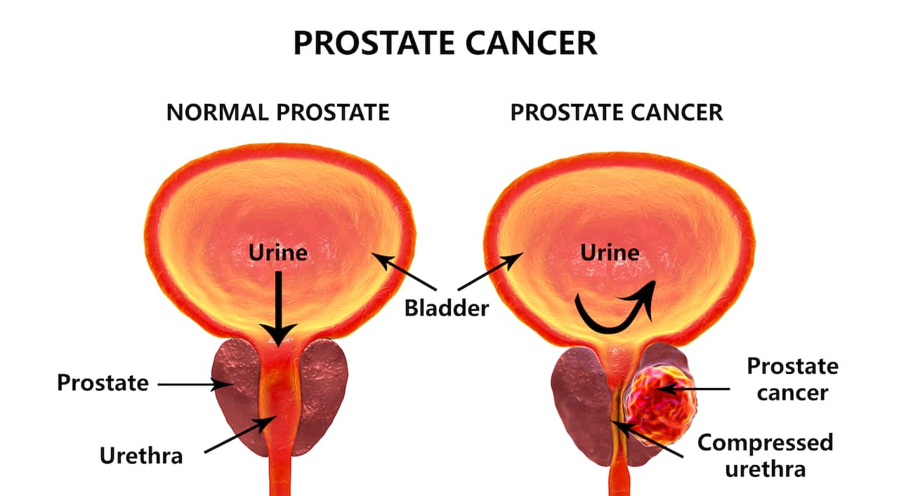 Prostate cancer, illustration