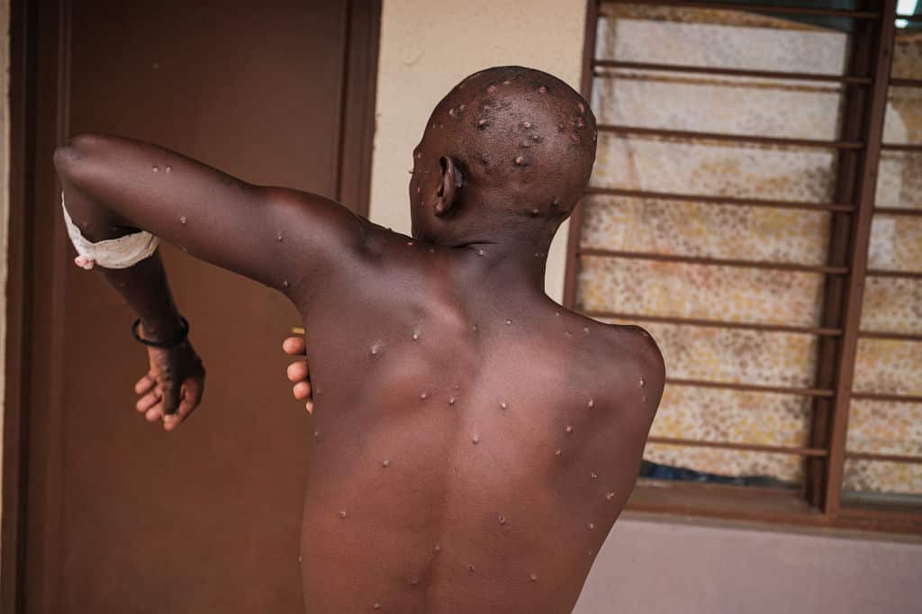 BURUNDI-HEALTH-VIRUS-MPOX