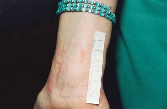 A woman's wrist, showing injuries, with a teal bracelet above them.