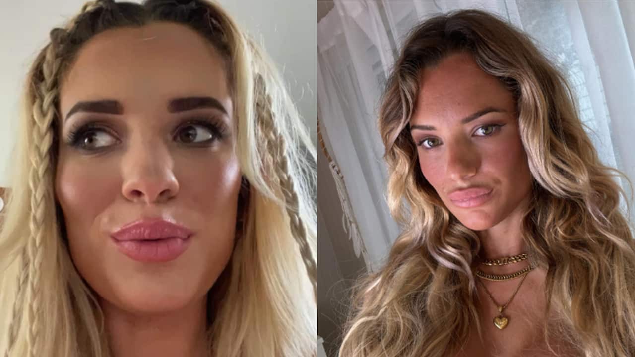 Tilly had her filler dissolved