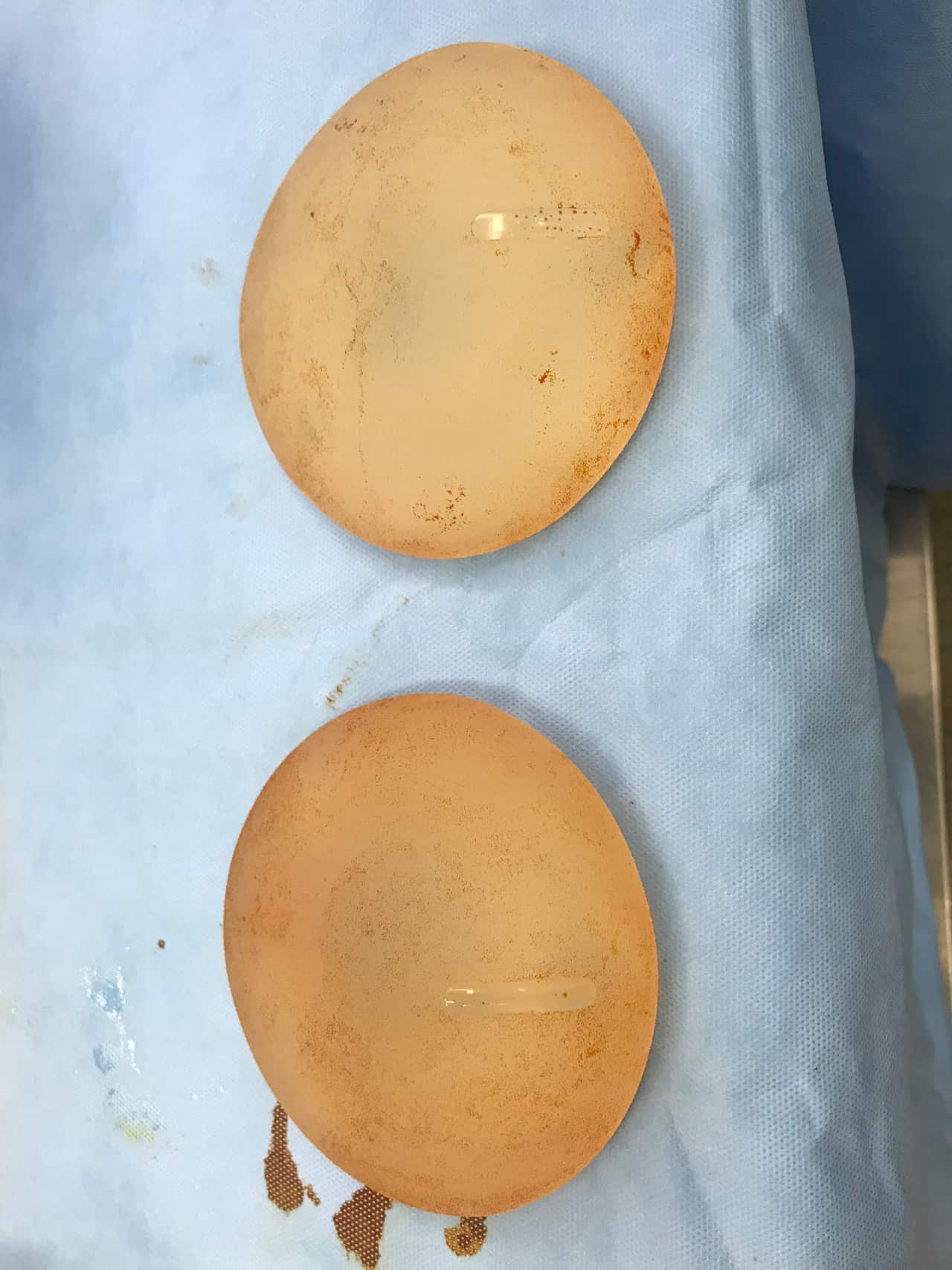 A pair of breast implants, removed from the body.