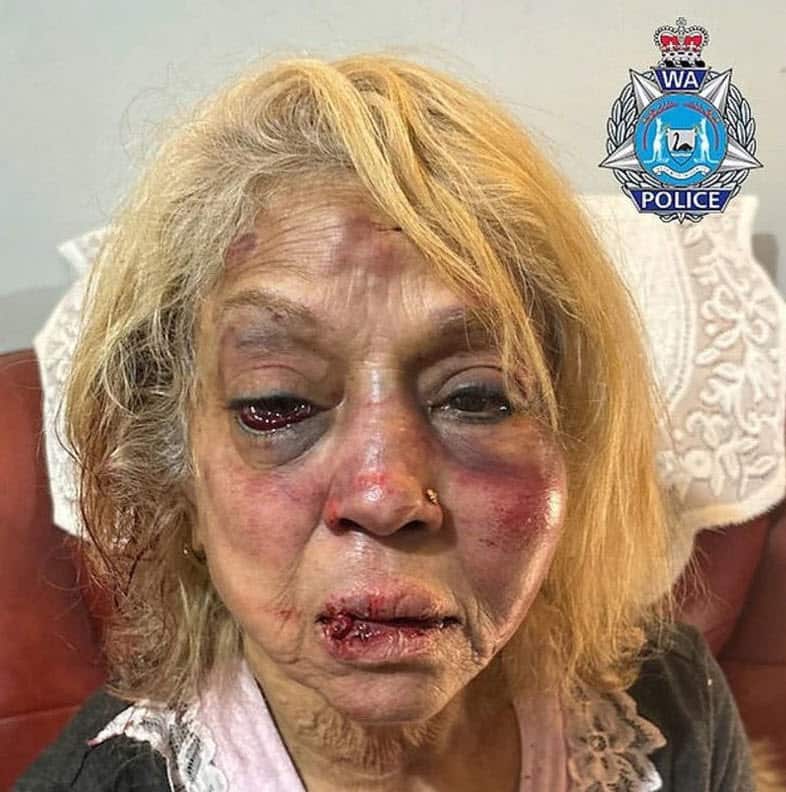 A woman with a badly bruised face