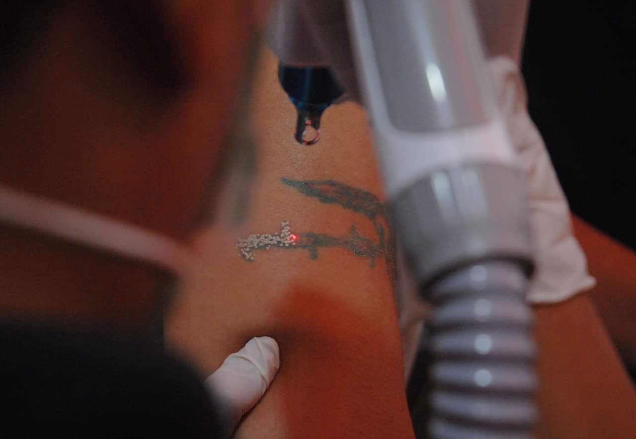 A gloved person holds a laser beam over his client's tattoo.
