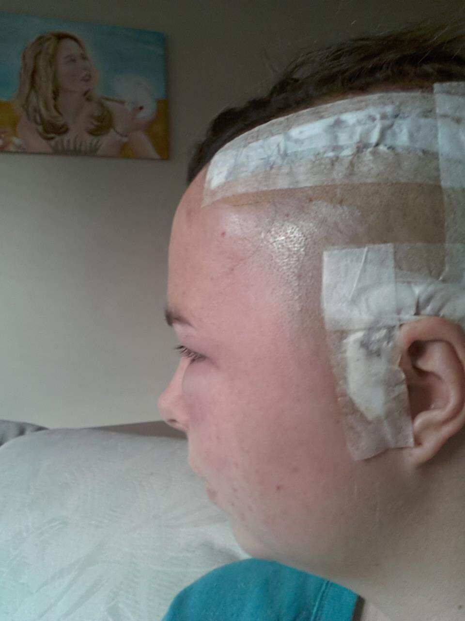 Hannah with a bandaged head after surgery