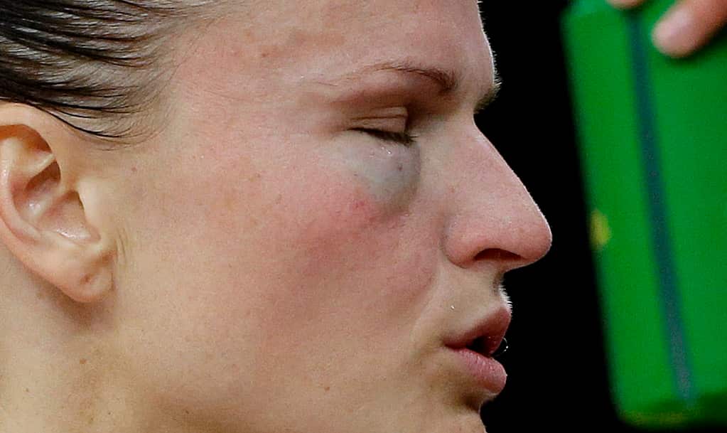 A close up shot of a woman's face. She has a swollen and bruised eye.
