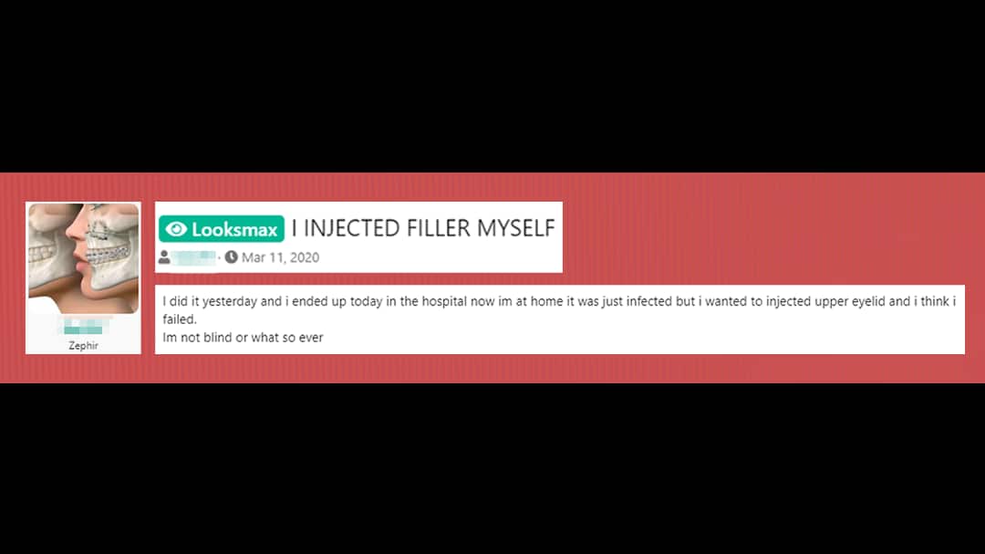 A post from a looksmaxxing forum, where a user talks about ending up in hospital after self-injecting filler 