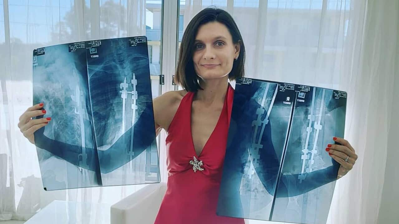 Elena Yakovleva from Sydney defeated scoliosis