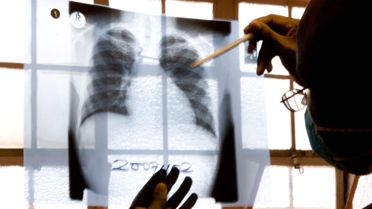 A doctor examines chest X-rays at a tuberculosis clinic in Gugulethu, Cape Town, South Africa, Friday, Nov. 9, 2007. (AP/Karin Schermbrucker)