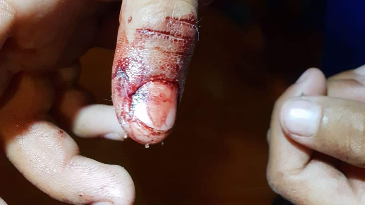 The nine-year old boy's hand bleeding from injuries he sustained after allegedly being locked in a cage at the rear of the IGA