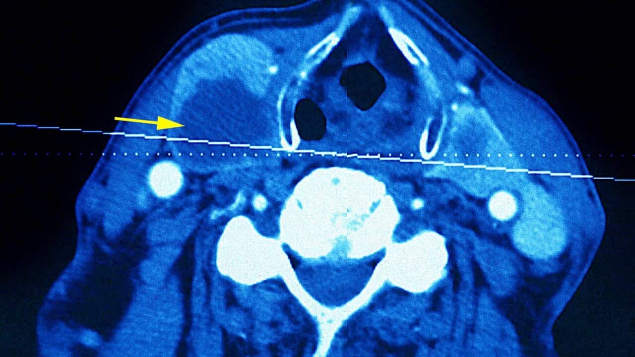 A CT scan of a neck showing a thyroid tumour
