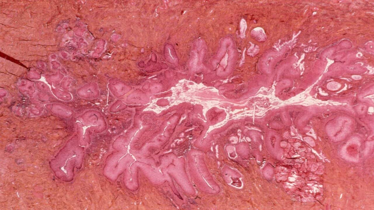 Cervical cancer