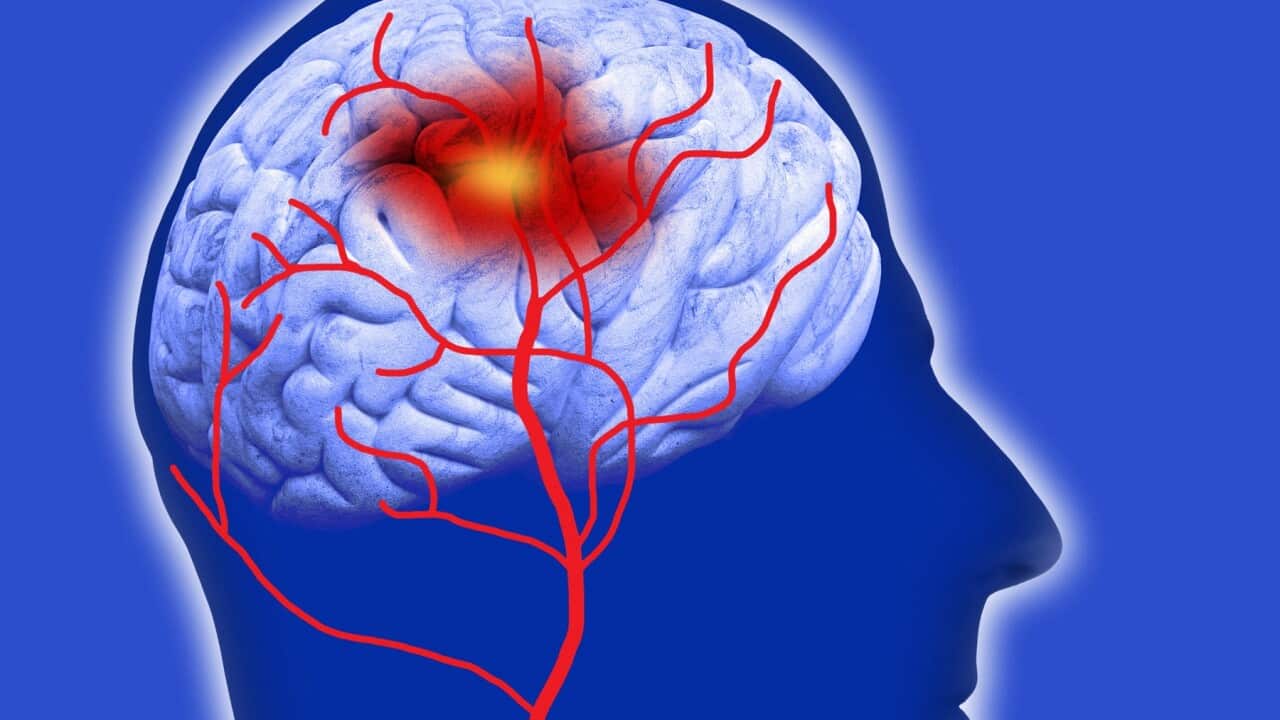 Human brain showing stroke.