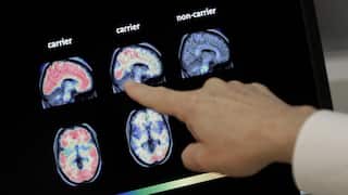 A hand points to brain scan images on a medical monitor comparing “carrier” and “non-carrier” brain activity patterns.