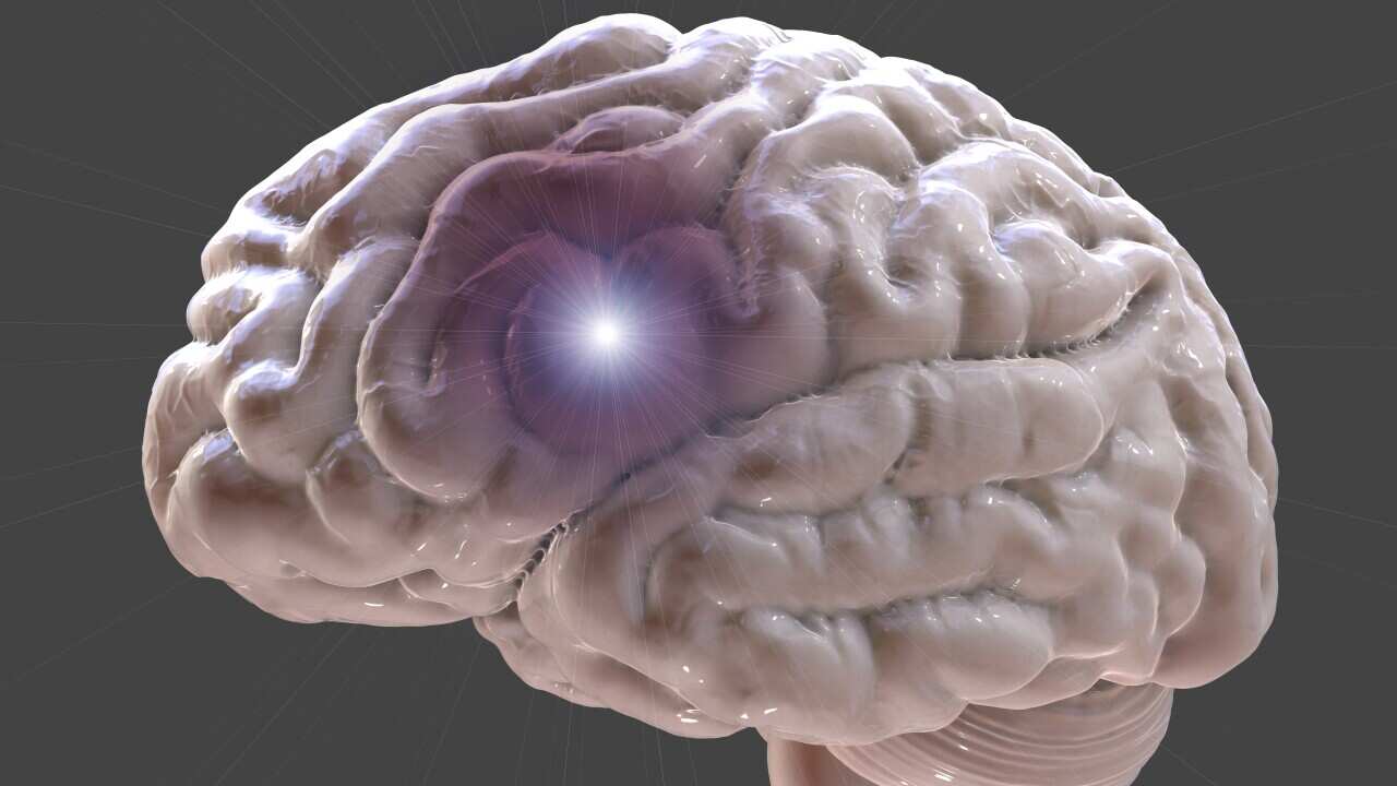 Stroke, illustration