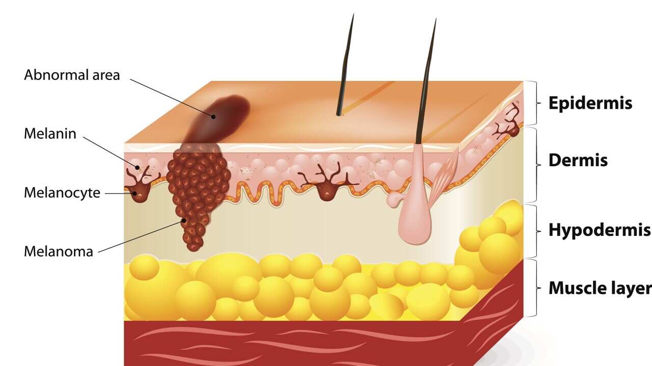 Melanoma or skin cancer