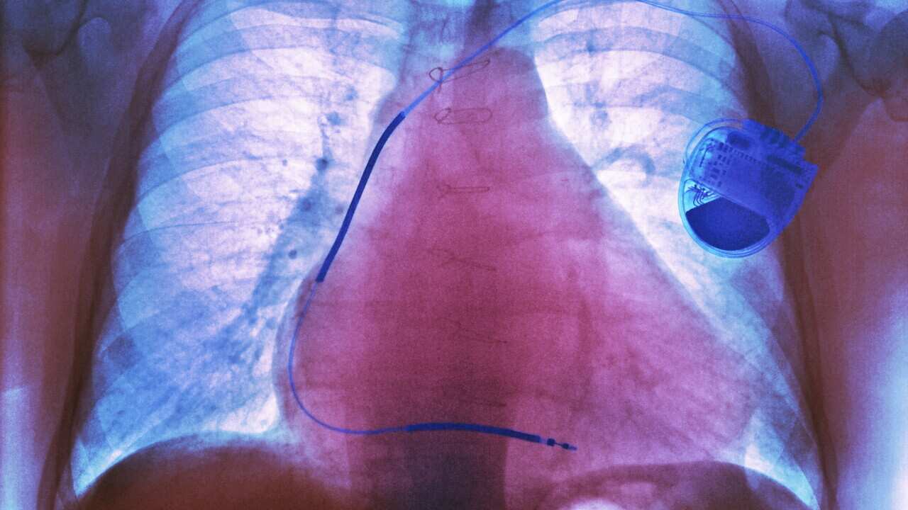 Pacemaker in heart disease, X-ray
