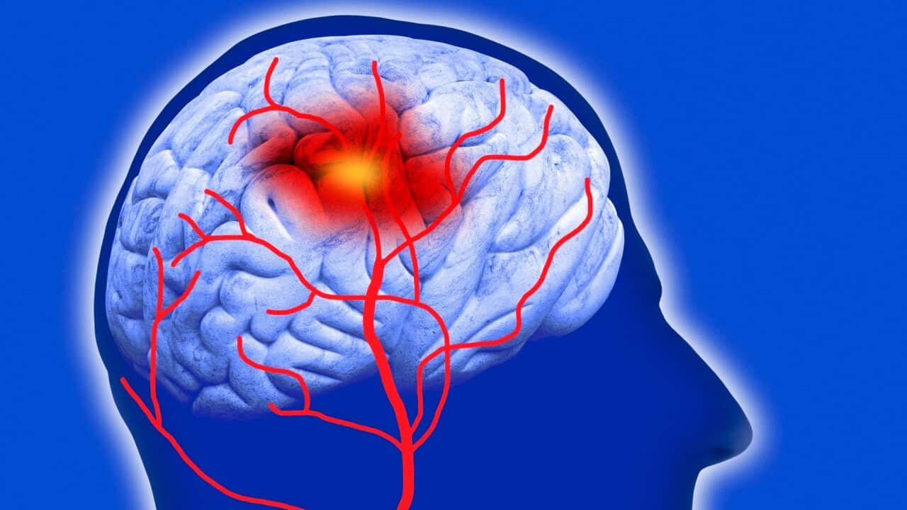 Human brain showing stroke