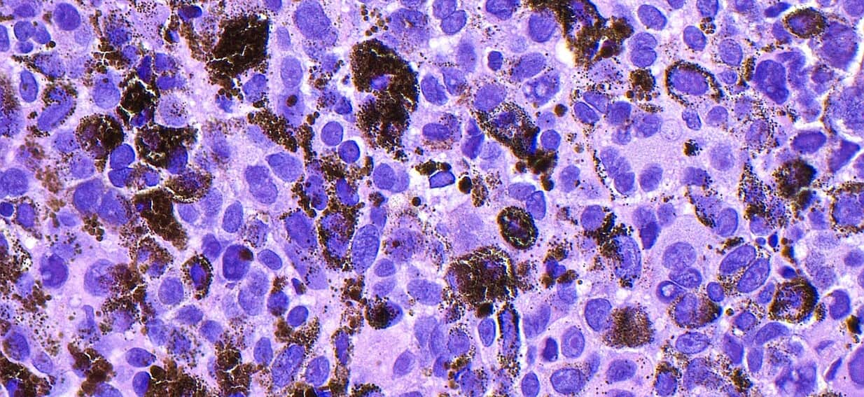 The common viral infections that are responsible for one in eight cancers