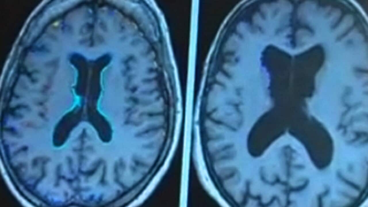 Alzheimer's disorder is one of the biggest health concerns facing Australians.