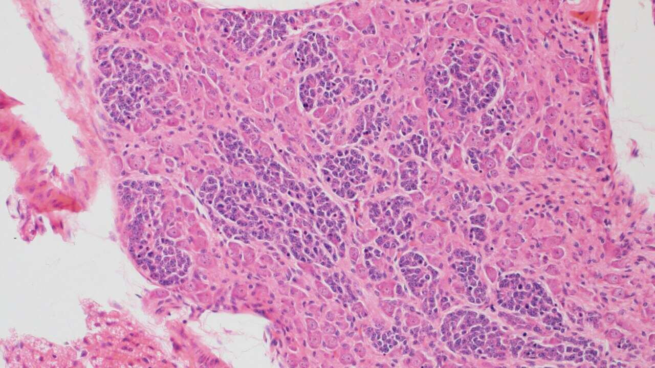 Neuroblastoma is a cancer of the nervous system that usually diagnosed when it's well advanced. (CCIA)