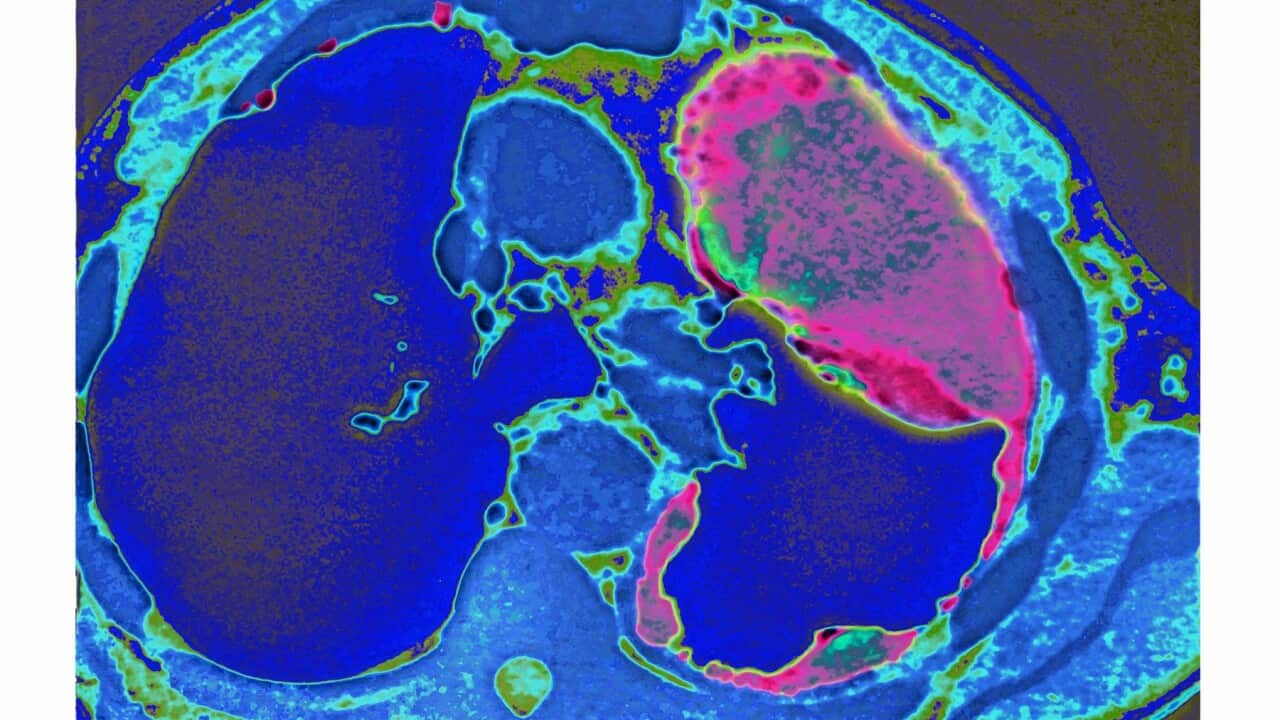 Lung cancer caused by asbestosis, seen on a radial section chest CT scan. (Photo by: BSIP/Universal Images Group via Getty Images)
