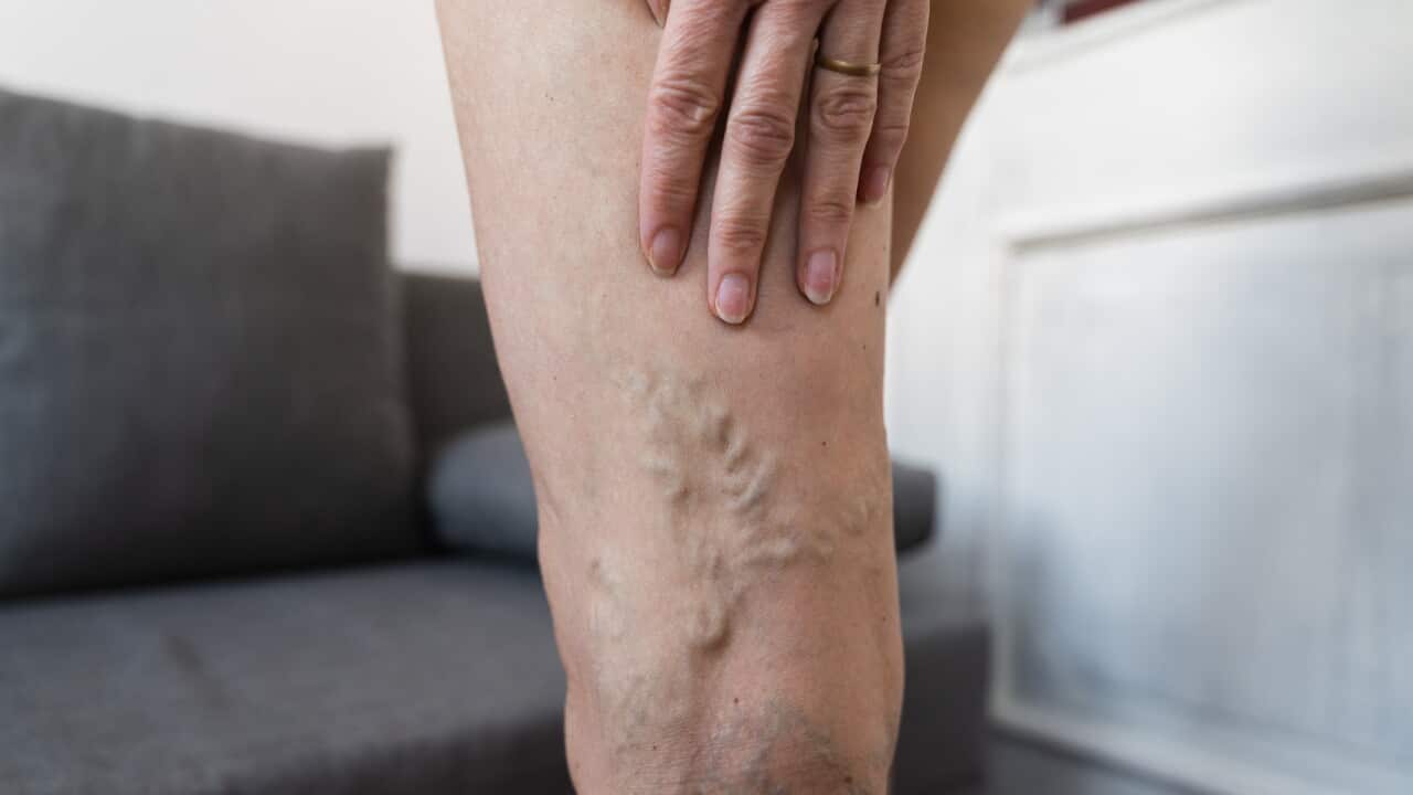 Close-up of varicose veins on woman leg