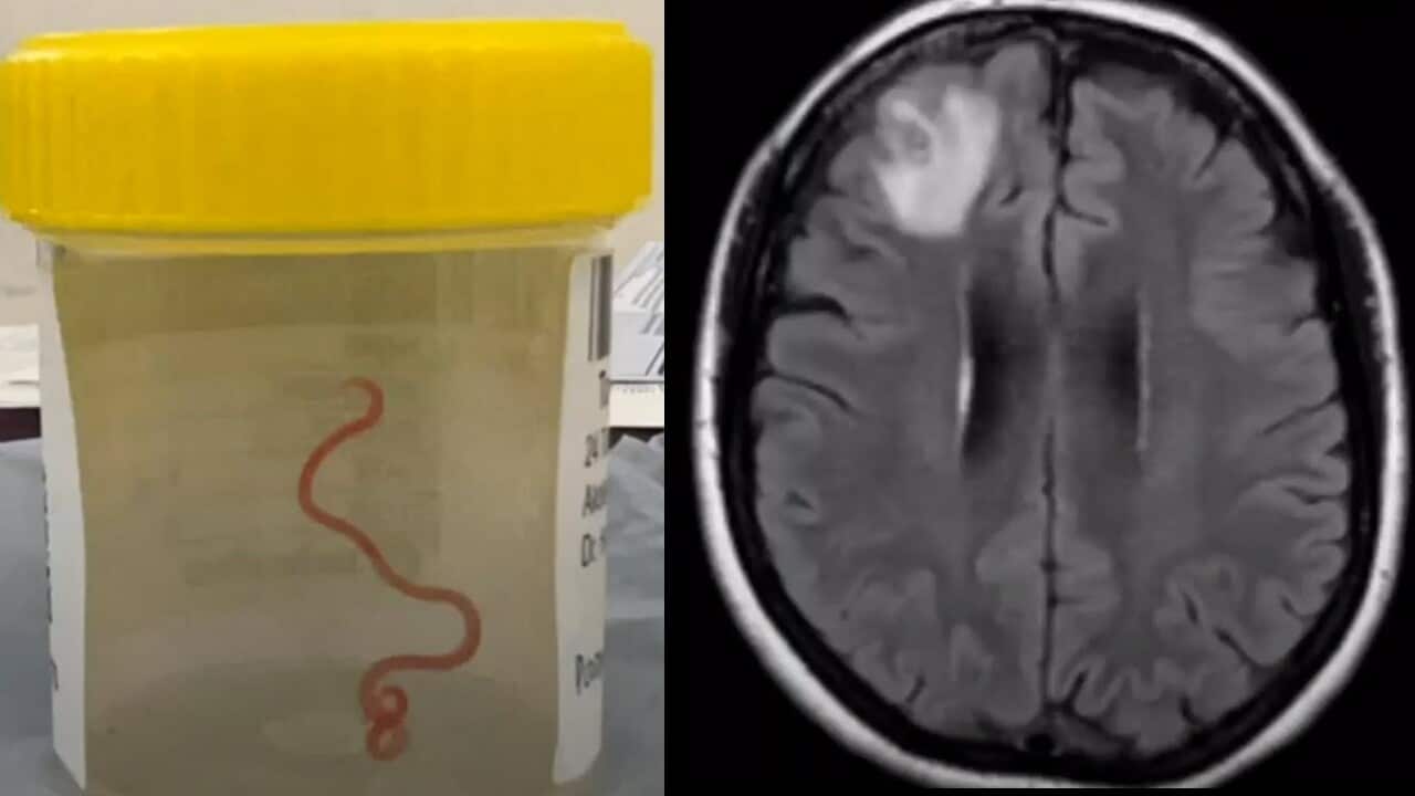 AUSTRALIA PARASITIC INFECTION DISCOVERY