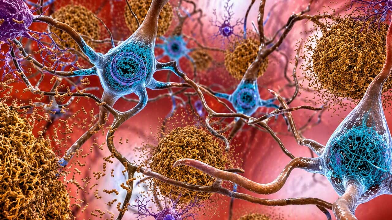 Illustration showing how tau and amyloid-β linked to dementia, form tangled sticky plaques in the brain (AP).jpg