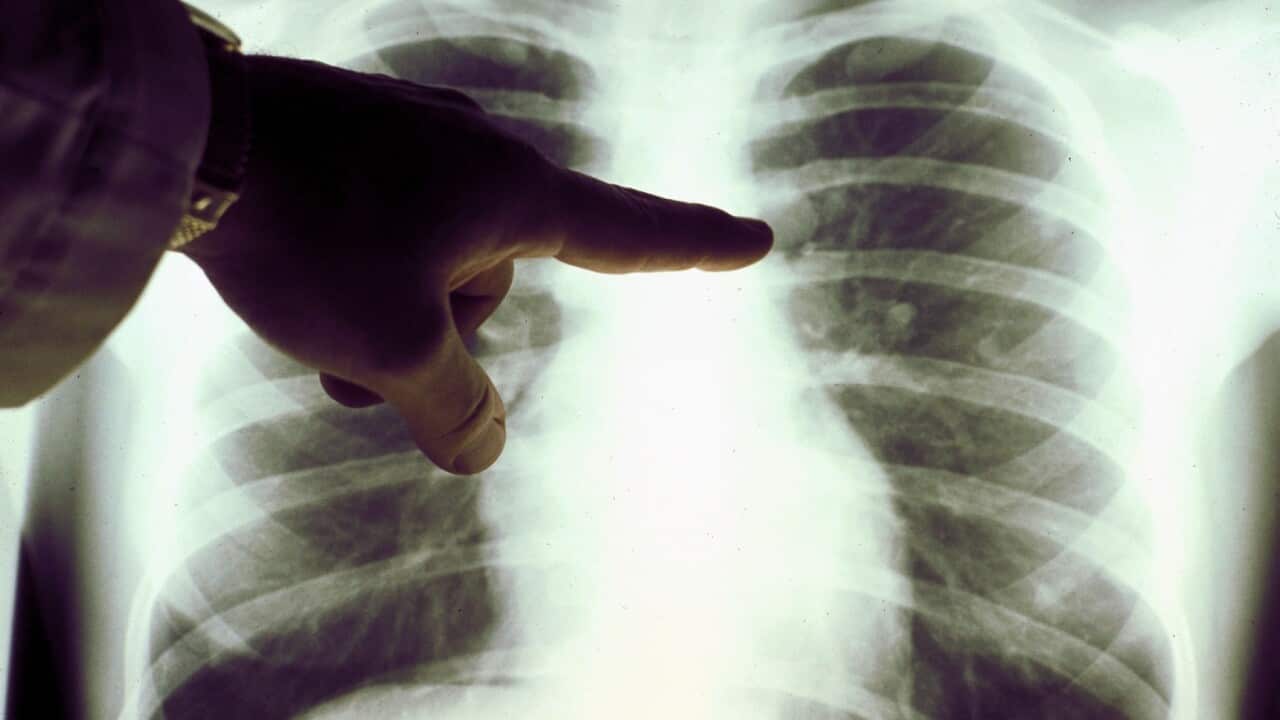 A doctor examines a lung x-ray