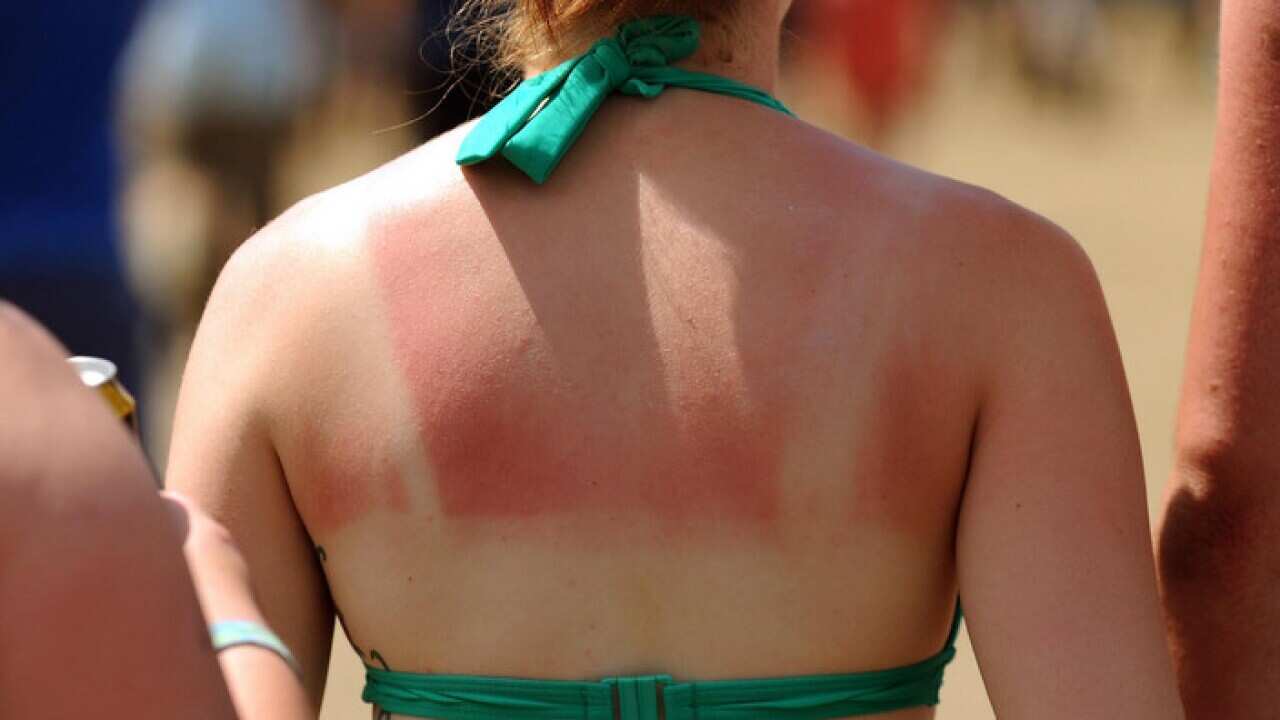 A woman with a sunburnt back (AAP)