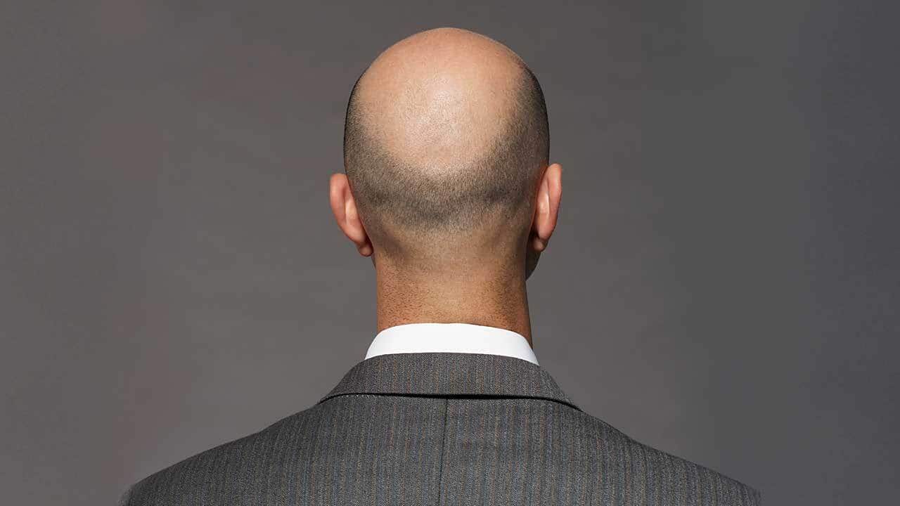 A study identifies that a possible cure for baldness may be found in a drug used to treat osteoporosis.