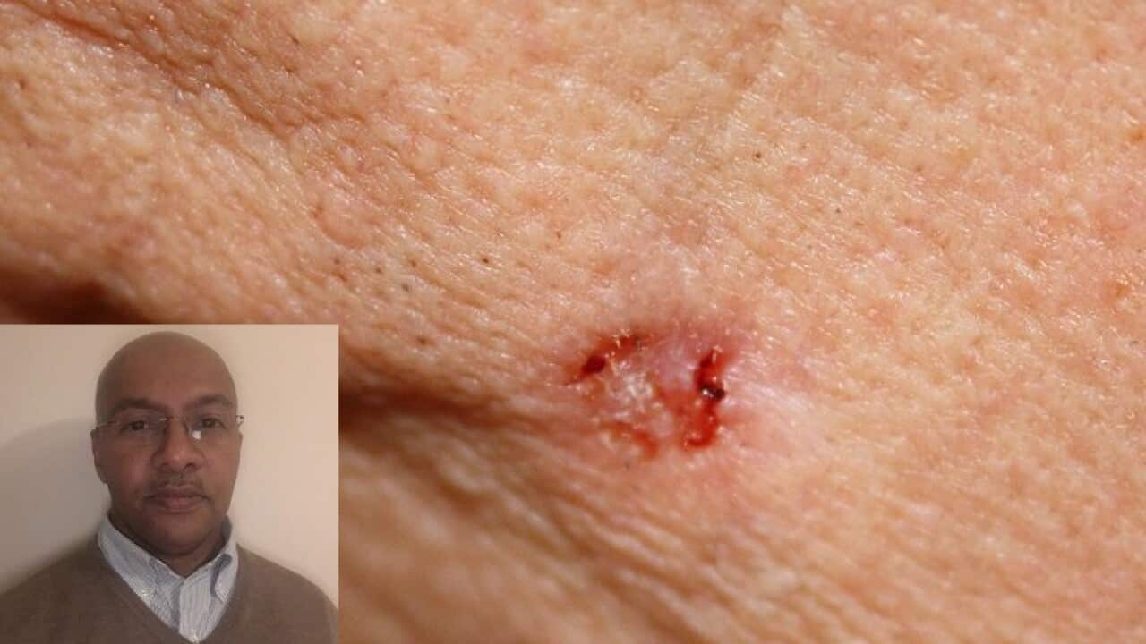 Skin cancer