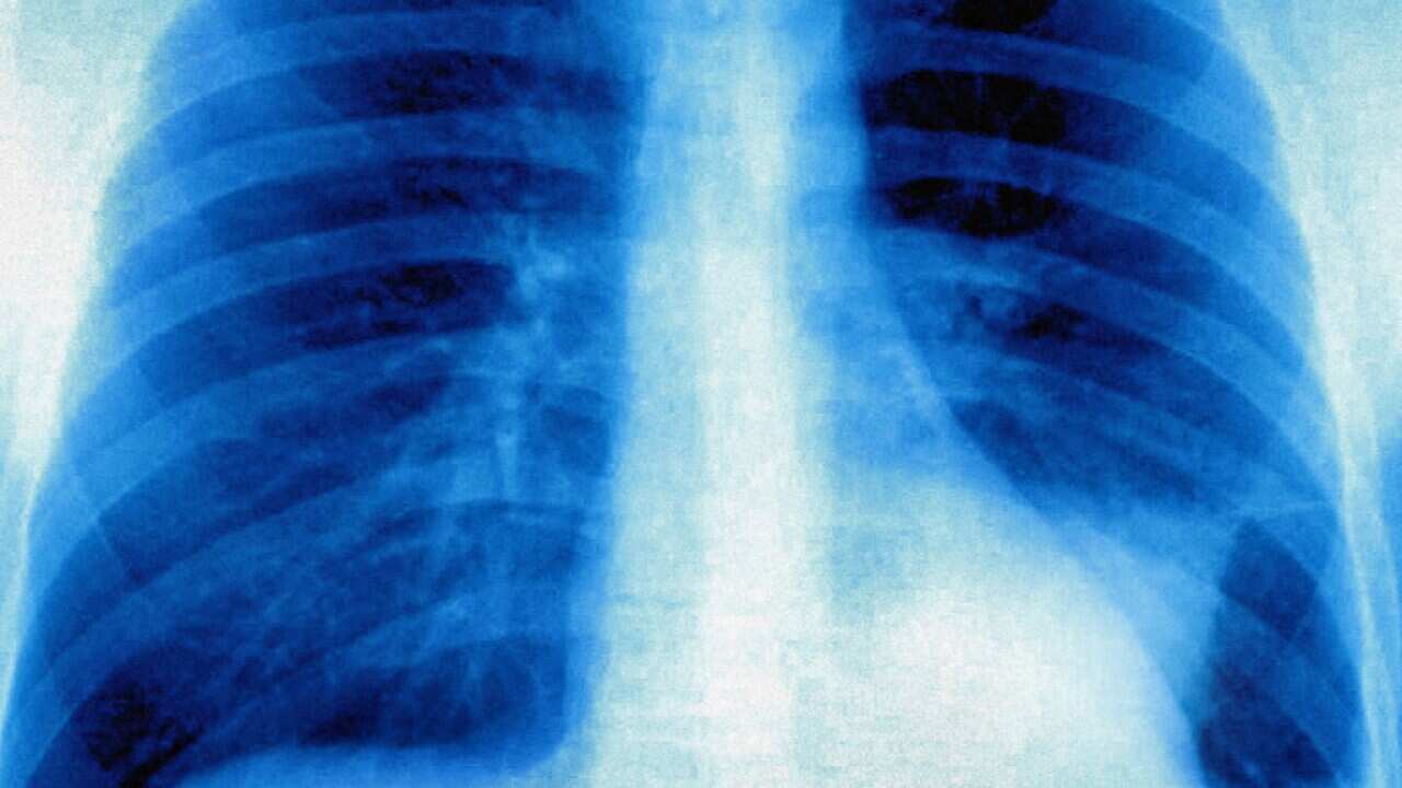 Lung cancer, x-ray