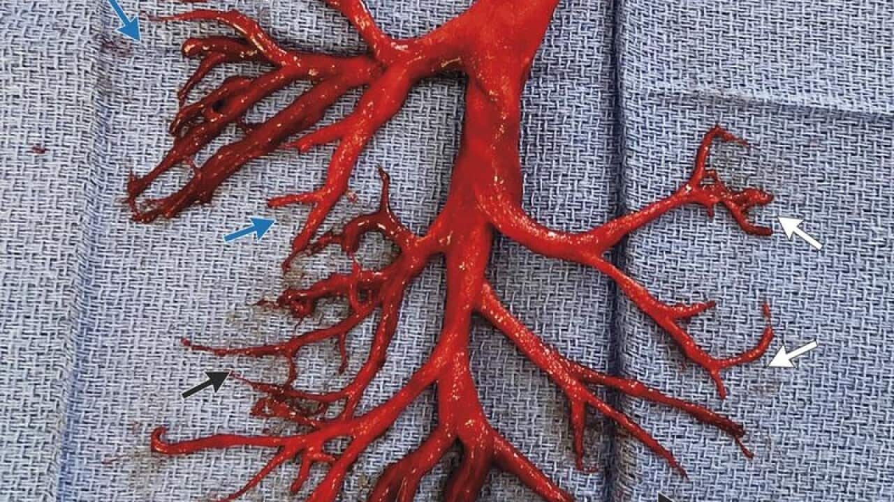 Blood clot in shape of a patient's bronchial tree