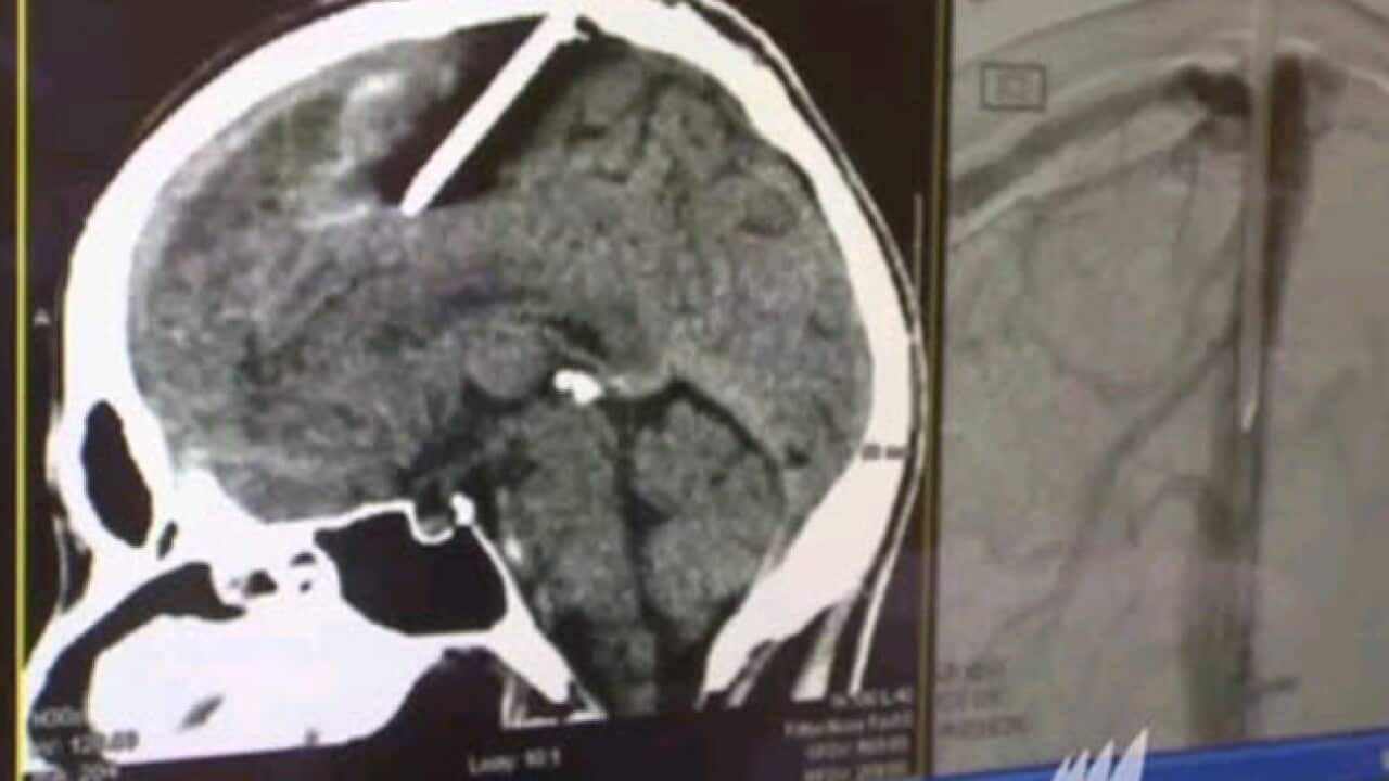 nailgun_brain_120208_b_CNN_1100341676