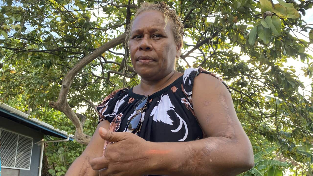 Maeverlyn Pitanoe with the scars from when a World War Two shell exploded beneath her feet.