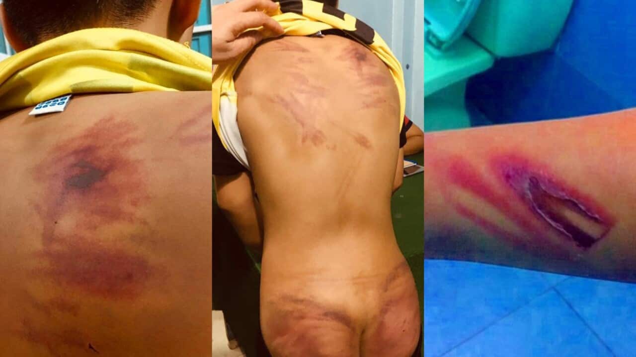 Những vết thương bầm tím trên người bé K. do bị đánh đập.