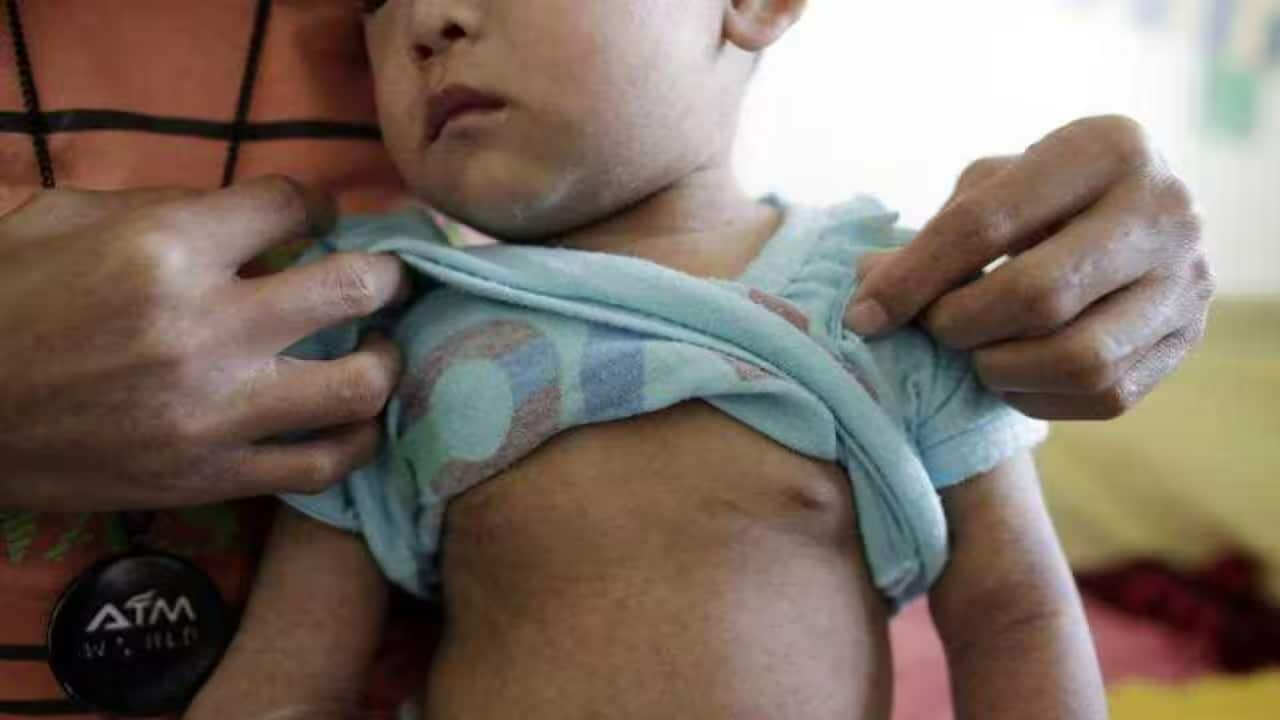 a measles.png