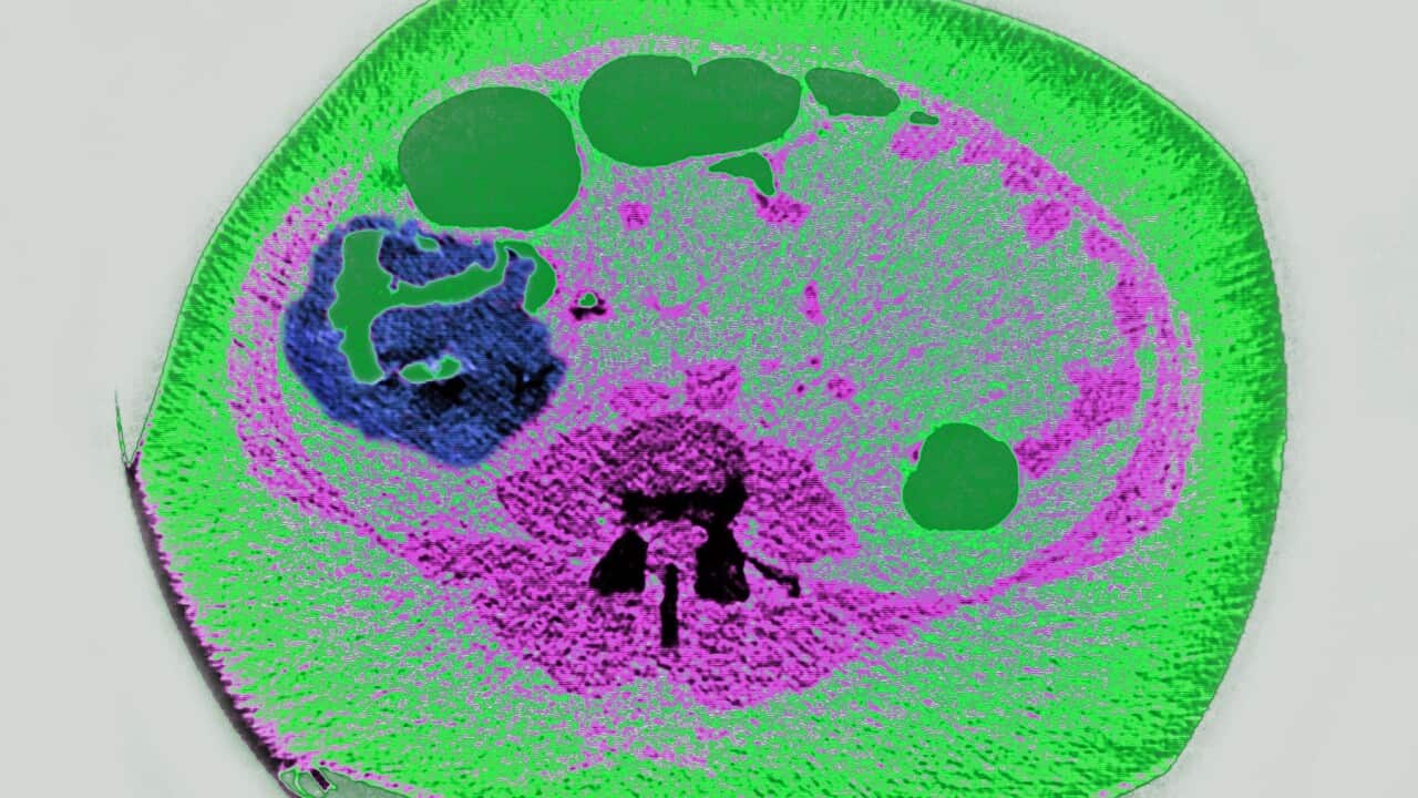 A radial CT Scan of a tumour in the colon