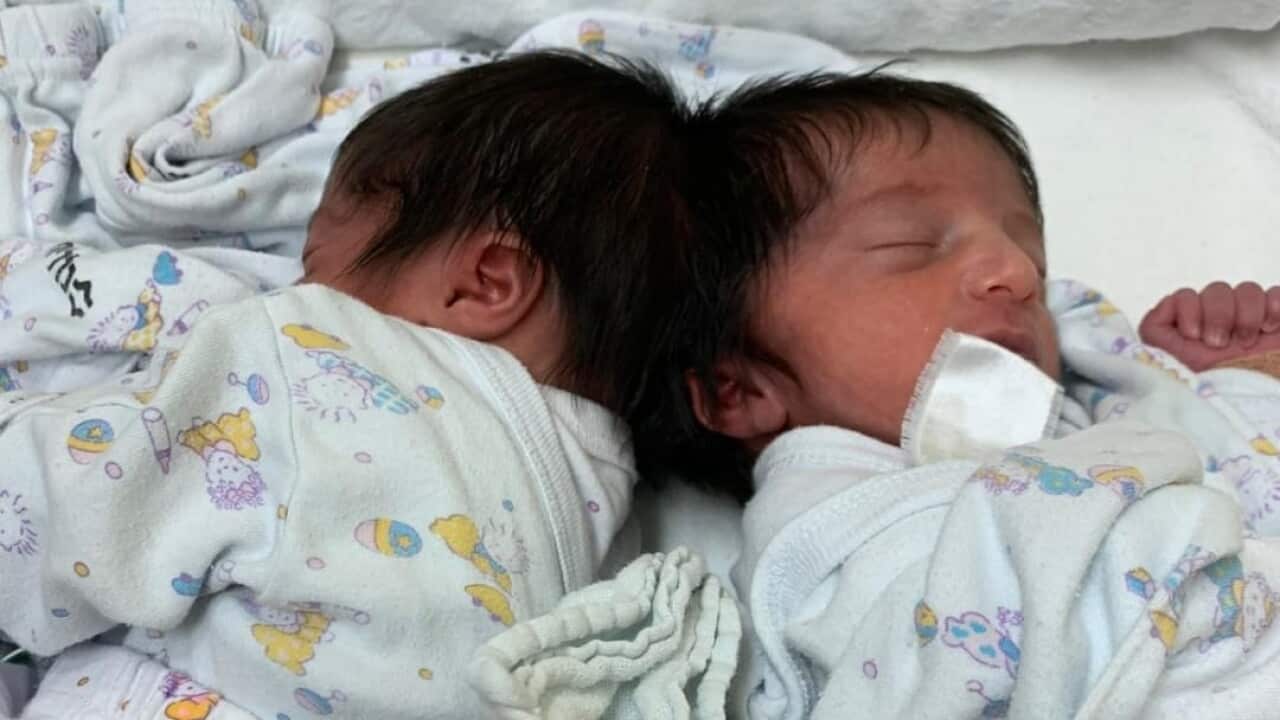 Conjoined twins before they were separated in a rare 12-hour surgery