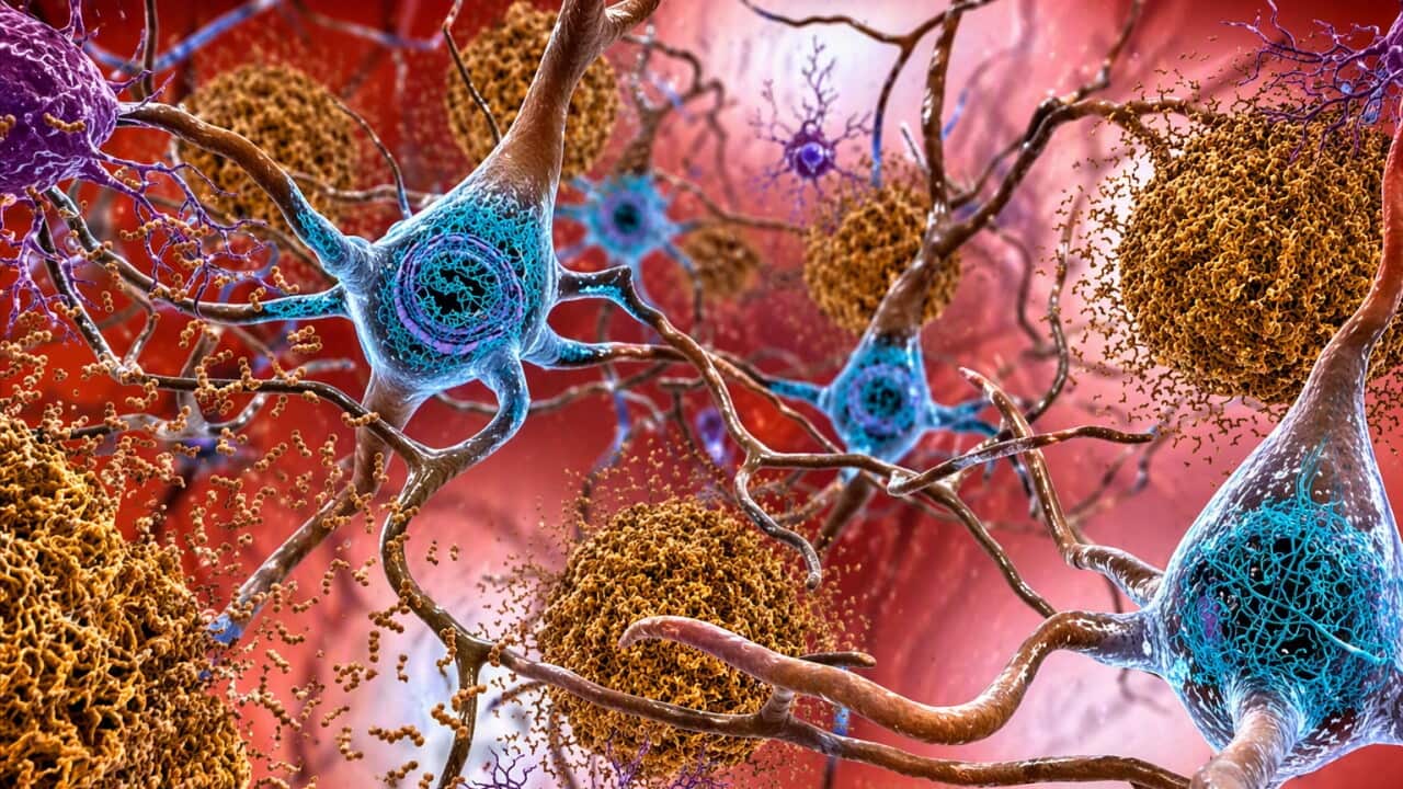 Illustration showing how tau and amyloid-β linked to dementia, form tangled sticky plaques in the brain (AP).jpg