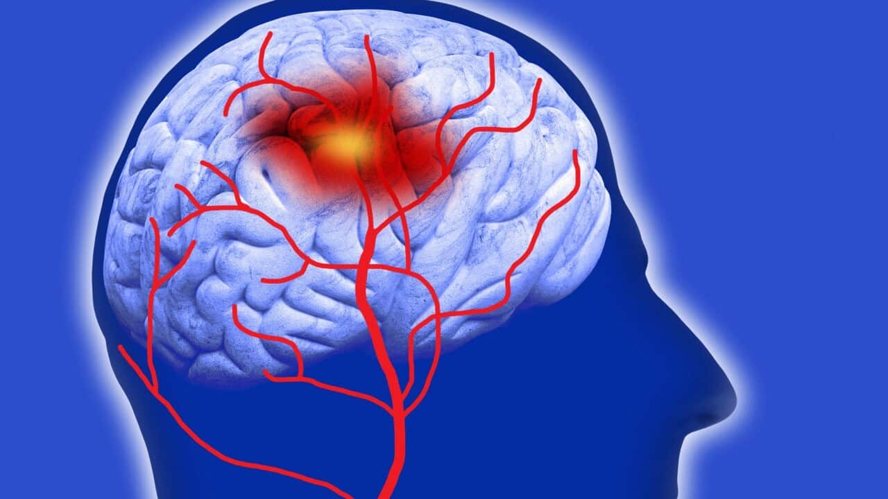 Human brain showing stroke