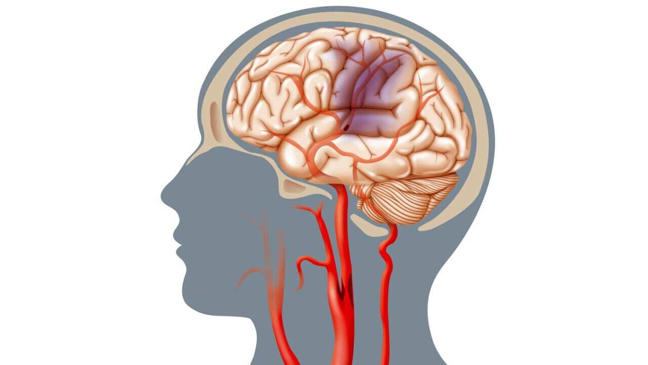 "Mini" strokes Illustration of a cerebrovascular accident (CVA) caused by an occlusion (atheromatous plaque which diminishes or obstructs the arterial lumen) in the carotid.